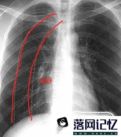 教你怎么看正常的胸片优质  第5张