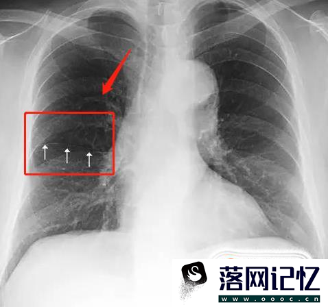 教你怎么看正常的胸片优质  第7张