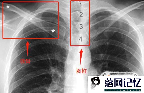 教你怎么看正常的胸片优质  第8张