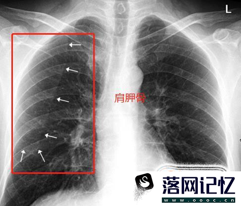 教你怎么看正常的胸片优质  第9张