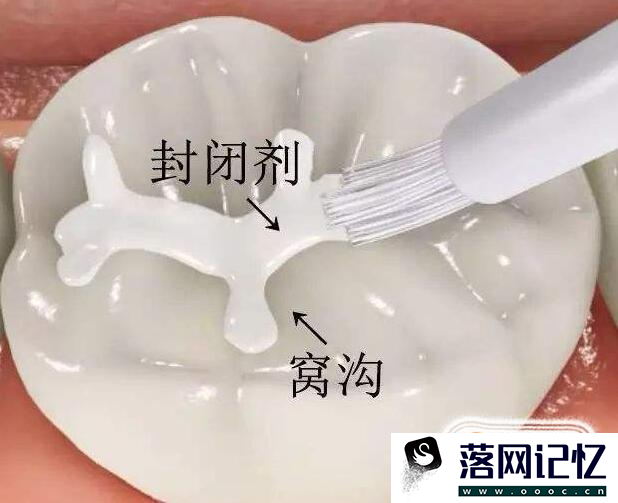 孩子做窝沟封闭有必要吗？优质  第3张