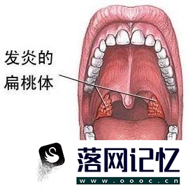 扁桃体化脓治疗方法优质  第1张