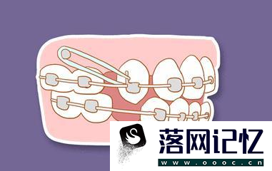 牙齿矫正改变我们脸型的步骤优质  第1张