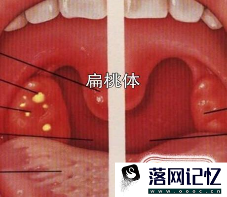 扁桃体化脓治疗方法优质  第9张