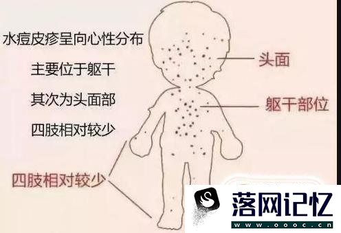 长水痘怎么办？水痘有什么症状？优质  第9张