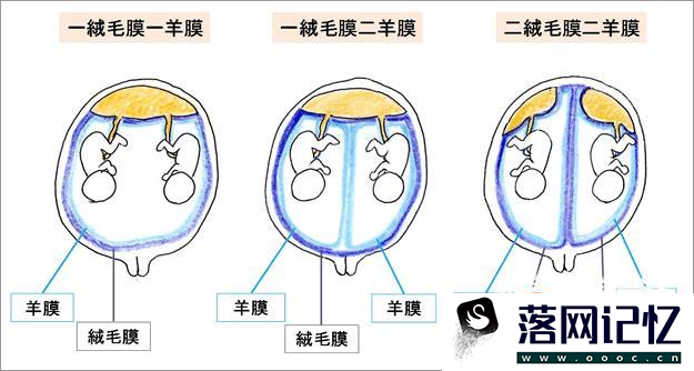 葡萄胎的鉴别诊断优质  第2张