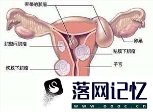 葡萄胎的鉴别诊断优质  第4张