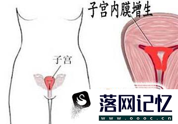 子宫内膜厚度正常值优质  第2张