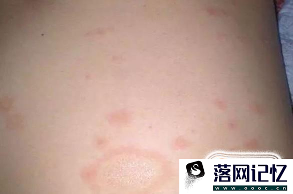 大腿内侧痒是什么病啊？最近痒得厉害总想抓优质  第6张