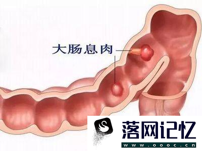 大肠息肉怎么治疗和预防，会癌变吗？优质  第1张