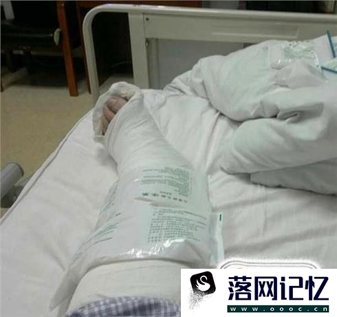 骨头裂了怎么办 骨头裂缝怎么办 骨裂怎么恢复优质  第4张