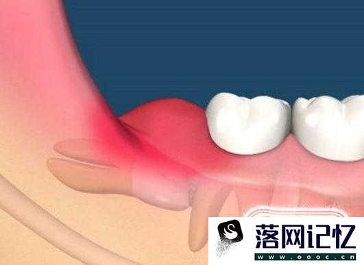 长出智齿了怎么办？什么样的智齿需要拔掉？优质  第1张