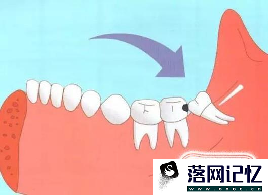 长出智齿了怎么办？什么样的智齿需要拔掉？优质  第7张