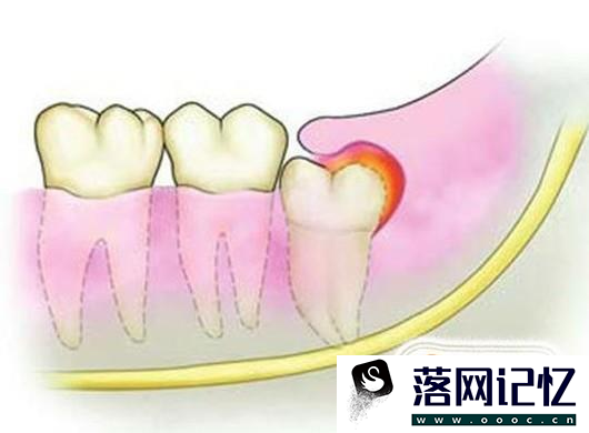 长出智齿了怎么办？什么样的智齿需要拔掉？优质  第8张