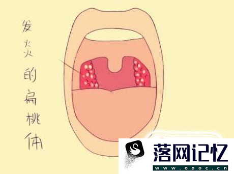 扁桃体发炎的症状以及预防方法优质  第3张