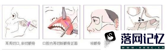 磨颧骨手术效果好不好？优质  第1张