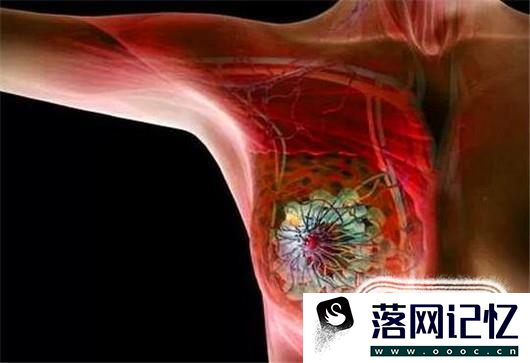 乳房有肿块是什么原因？该如何消除乳房肿块？优质  第4张