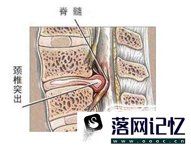 颈椎突出能复位吗？ 为什么优质  第1张