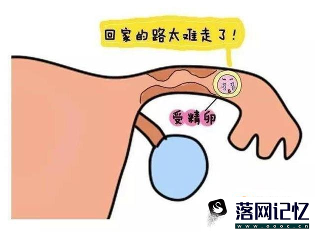 造成宫外孕的原因有哪些优质  第3张