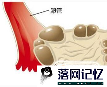 多囊卵巢综合症怎样治疗？优质  第1张