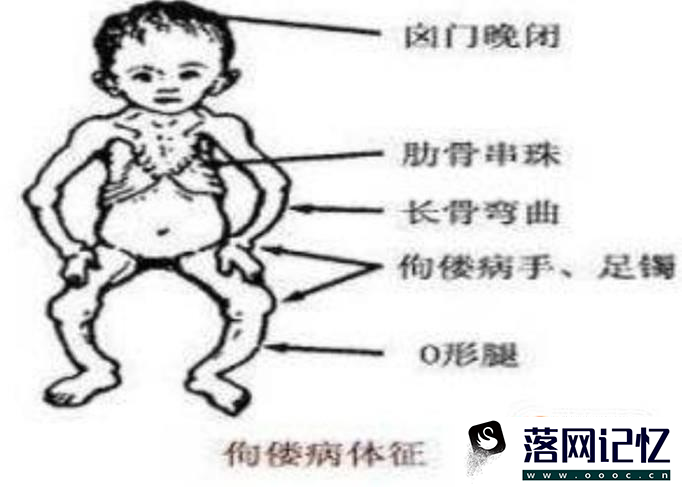 什么是维生素D缺乏性佝偻病优质  第3张