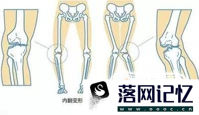 佝偻病与软骨病的区别优质  第4张