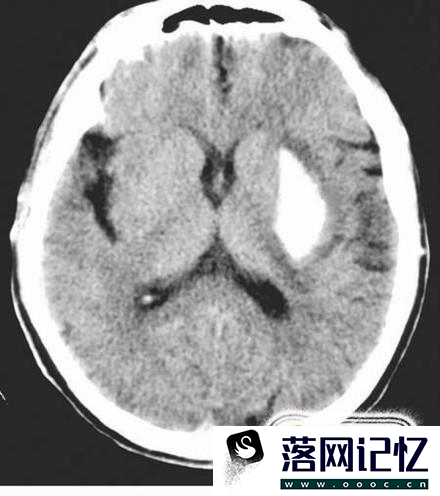 植物人的病因是什么 为什么会变成植物人优质  第3张