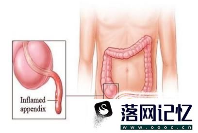 阑尾炎一定要做手术吗？优质  第1张