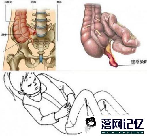 阑尾炎一定要做手术吗？优质  第3张