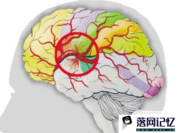 脑溢血是什么意思优质  第1张