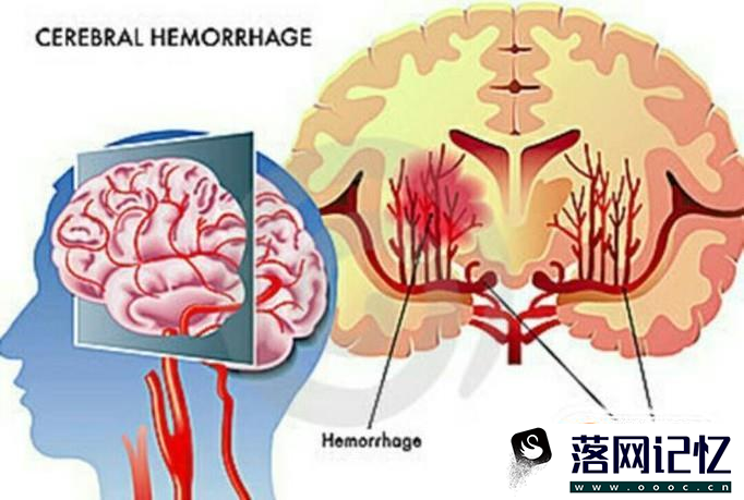 脑溢血是什么意思优质  第2张