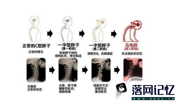 颈椎病为何会引发头痛优质  第3张