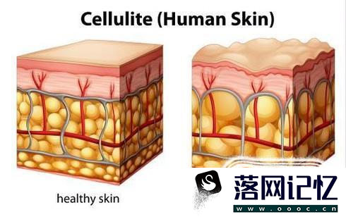 什么是糖尿病酮症酸中毒优质  第2张