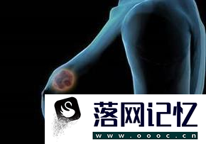 女性必知：乳腺癌早期五大症状优质  第2张