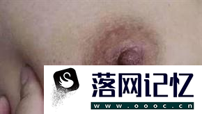 女性必知：乳腺癌早期五大症状优质  第3张