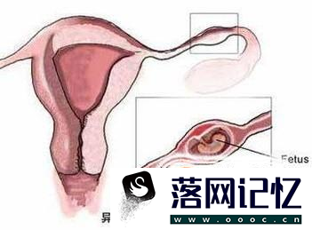 如何分辨宫内孕和宫外孕优质  第2张