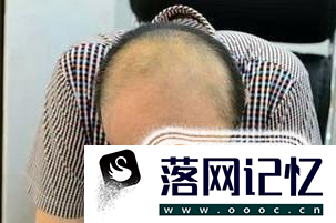 发际线高的人更容易秃头吗？为什么？优质  第1张