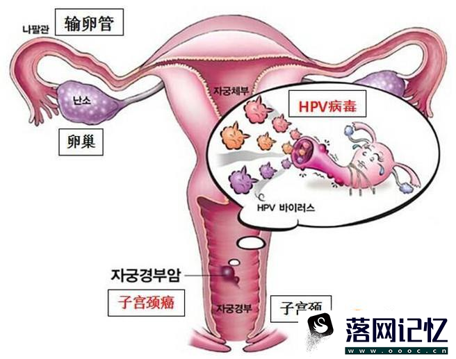 什么是宫颈癌 怎样预防宫颈癌优质  第2张